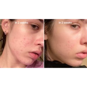 سرم ضد لک نیاسینامید آنوا